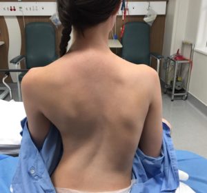 Chloe Park Scoliosis